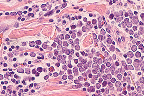 Merkel cell carcinoma cells